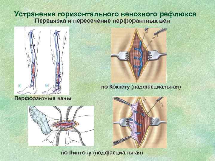 Устранение горизонтального венозного рефлюкса Перевязка и пересечение перфорантных вен по Коккету (надфасциальная) Перфорантные вены