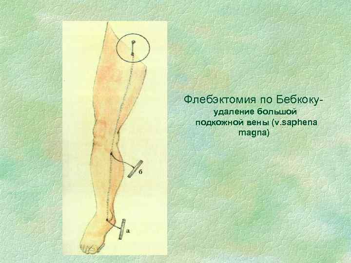 Флебэктомия по Бебкокуудаление большой подкожной вены (v. saphena magna) 