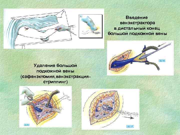 Введение венэкстрактора в дистальный конец большой подкожной вены Удаление большой подкожной вены (сафенэктомия, венэкстракциястриппинг)