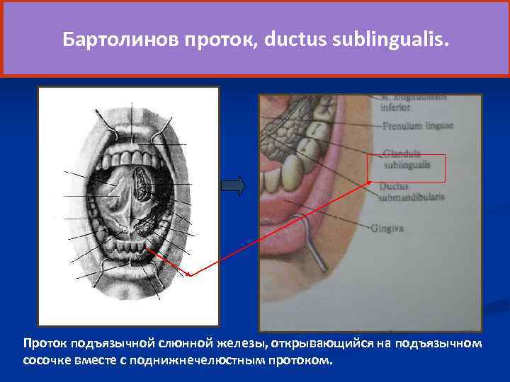  Бартолинов проток, ductus sublingualis. Проток подъязычной слюнной железы, открывающийся на подъязычном сосочке вместе