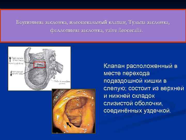 Баугиниева заслонка, илеоцекальный клапан, Тульпа заслонка, фаллопиева заслонка, valve ileocecalis. Клапан расположенный в месте