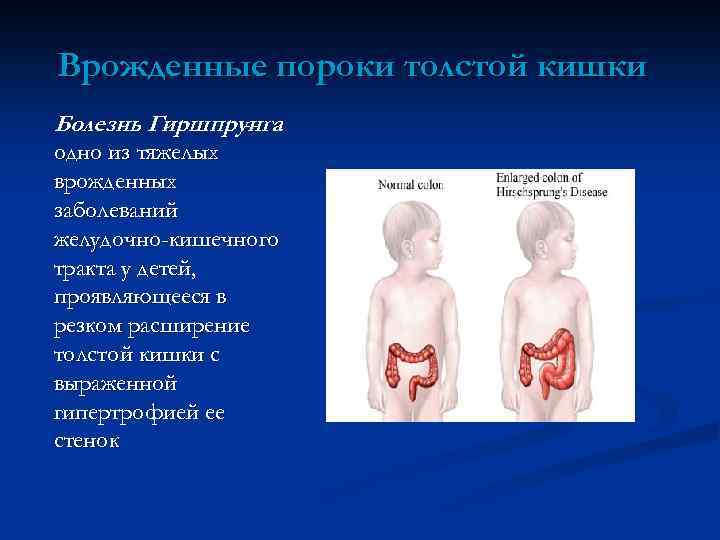 Врожденные пороки толстой кишки Болезнь Гиршпрунга - одно из тяжелых врожденных заболеваний желудочно-кишечного тракта