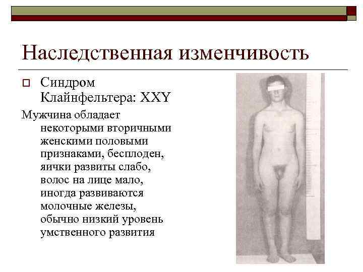 Наследственная изменчивость o Синдром Клайнфельтера: XXY Мужчина обладает некоторыми вторичными женскими половыми признаками, бесплоден,