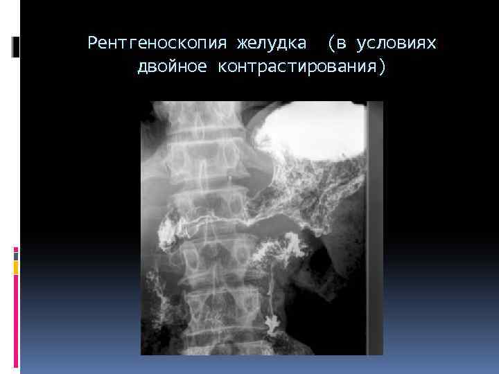 Рентгеноскопия желудка (в условиях двойное контрастирования) 