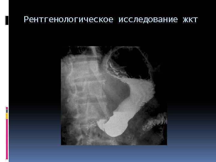 Исследование жкт. Рентгеноконтрастное исследование желудка. Рентгенологическое исследование ЖКТ. Рентгенологическое исследование органов пищеварения. Рентгенологические методы исследования ЖКТ.