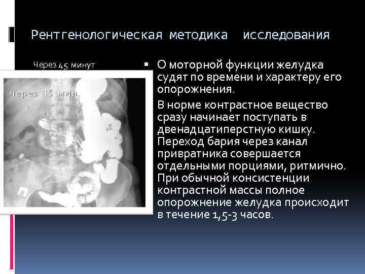 Рентгенологическая методика исследования Через 45 минут О моторной функции желудка судят по времени и
