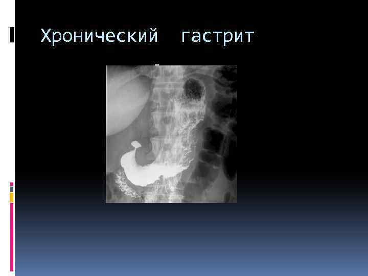 Хронический . гастрит 