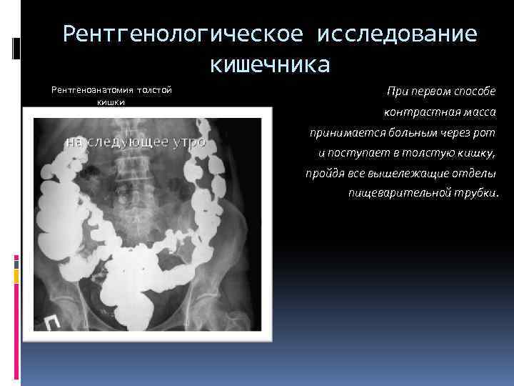 Исследование кишечных. Рентгенологический метод исследования Толстого кишечника. Рентген метод исследования Толстого кишечника. Методики рентгенологического исследования толстой кишки. Рентгенология исследование Толстого кишечника.