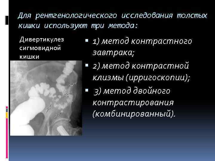 Для рентгенологического исследования толстых кишки используют три метода: Дивертикулез сигмовидной кишки 1) метод контрастного