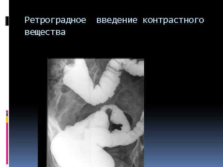Ретроградное вещества введение контрастного 