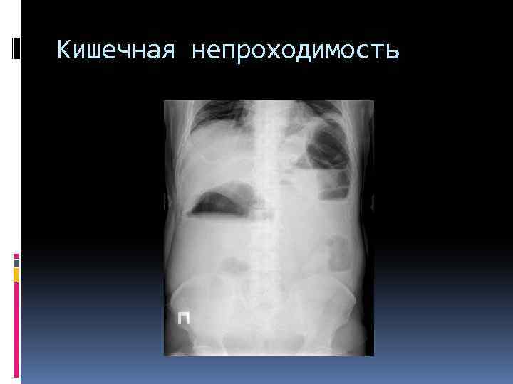 Кишечная непроходимость 
