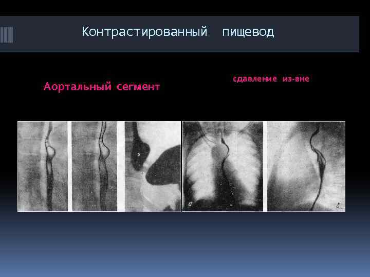 Контрастированный Аортальный сегмент пищевод сдавление из-вне 