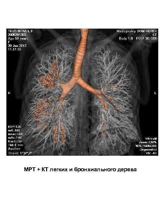 МРТ + КТ легких и бронхиального дерева 
