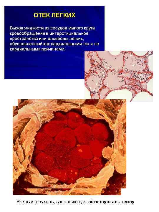Раковая опухоль, заполняющая лёгочную альвеолу 