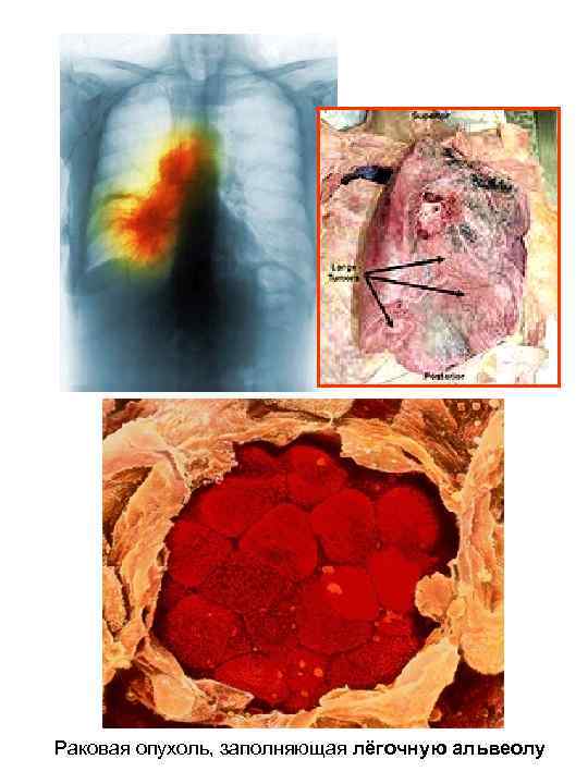 Раковая опухоль, заполняющая лёгочную альвеолу 
