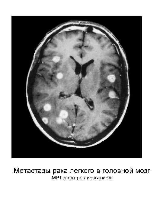 Метастазы рака легкого в головной мозг МРТ с контрастированием 