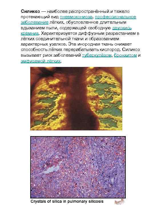 Силикоз — наиболее распространённый и тяжело протекающий вид пневмокониоза, профессиональное заболевание лёгких, обусловленное длительным