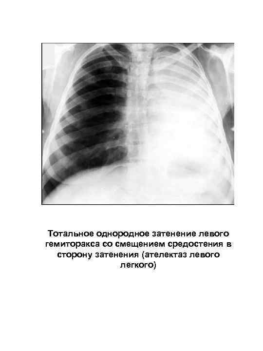 Тотальное однородное затенение левого гемиторакса со смещением средостения в сторону затенения (ателектаз левого легкого)
