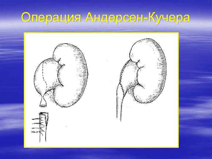 Осложнения гидронефроза