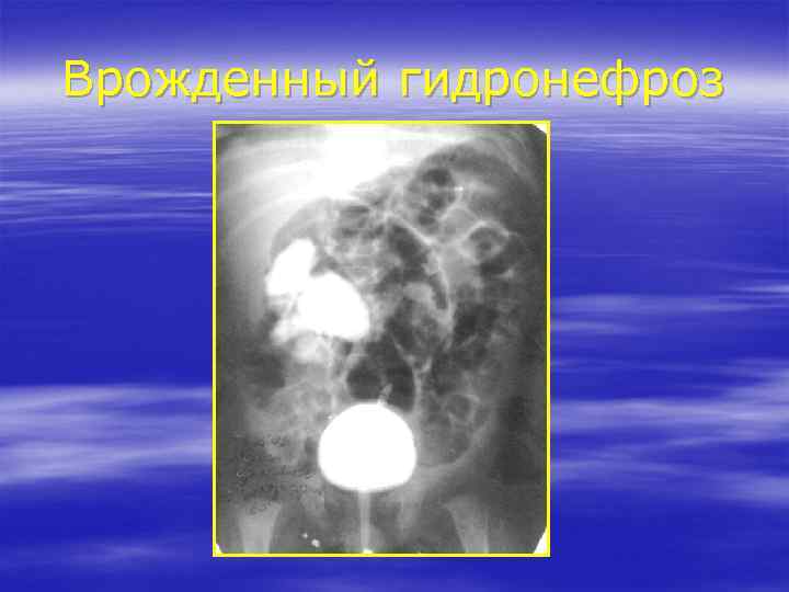 Врожденный гидронефроз 