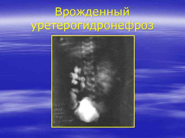 Врожденный уретерогидронефроз 