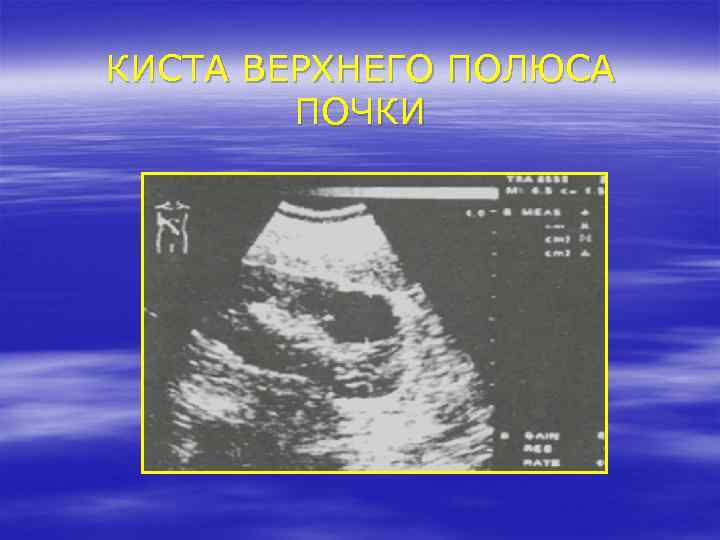 КИСТА ВЕРХНЕГО ПОЛЮСА ПОЧКИ 