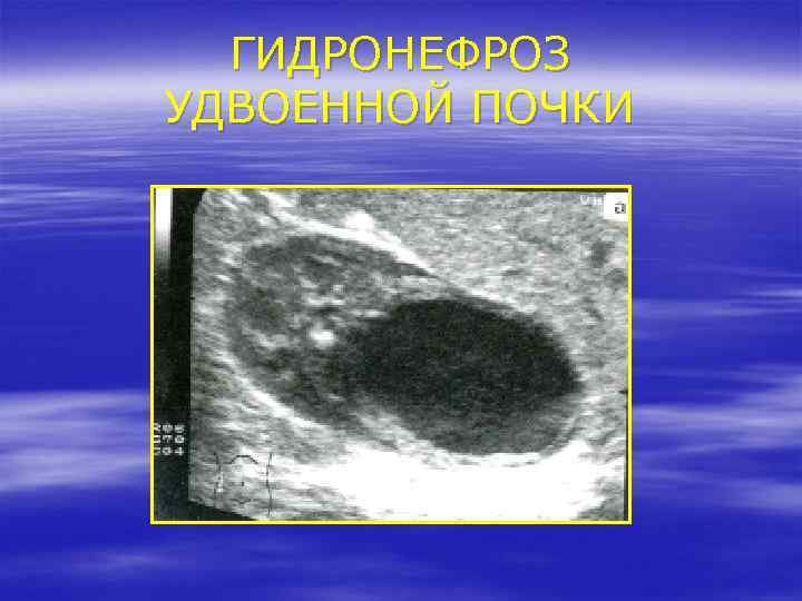 ГИДРОНЕФРОЗ УДВОЕННОЙ ПОЧКИ 