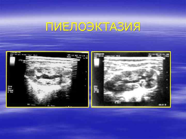 ПИЕЛОЭКТАЗИЯ 