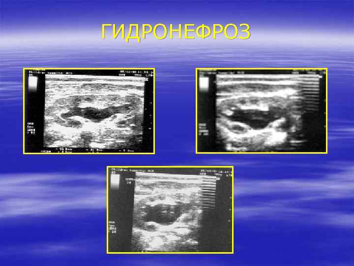 ГИДРОНЕФРОЗ 