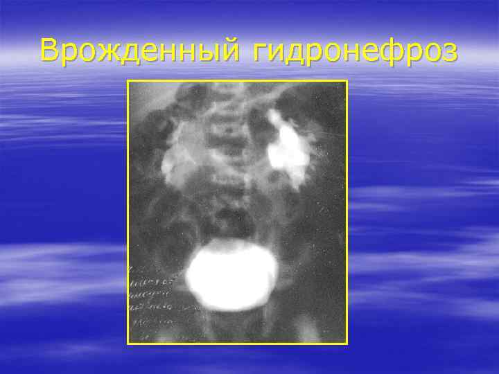 Врожденный гидронефроз 