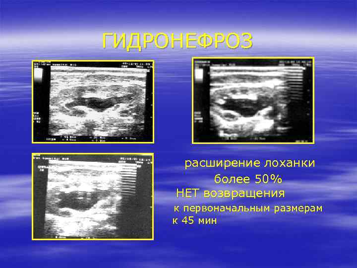ГИДРОНЕФРОЗ расширение лоханки более 50% НЕТ возвращения к первоначальным размерам к 45 мин 