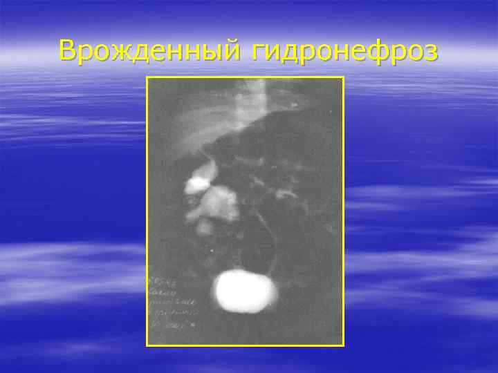 Врожденный гидронефроз 