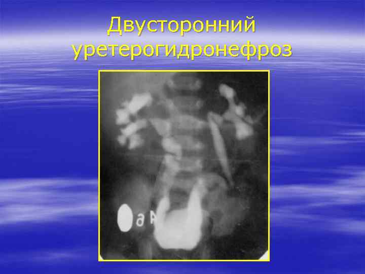 Двусторонний уретерогидронефроз 