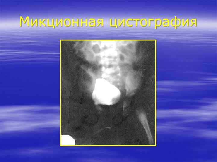 Микционная цистография 
