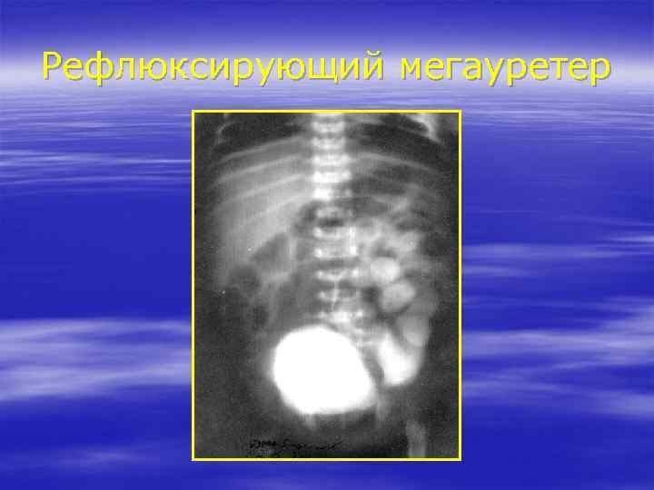 Рефлюксирующий мегауретер 