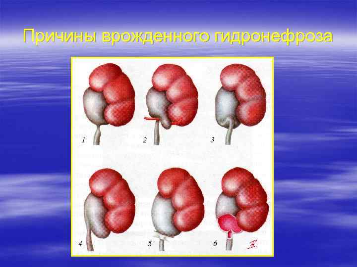 Причины врожденного гидронефроза 