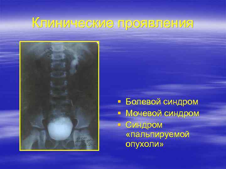 Клинические проявления § § § Болевой синдром Мочевой синдром Синдром «пальпируемой опухоли» 