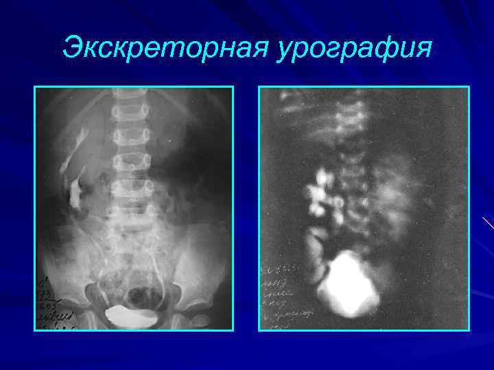 Экскреторная урография презентация