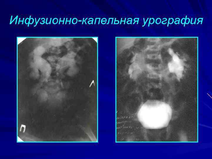 Инфузионно-капельная урография 