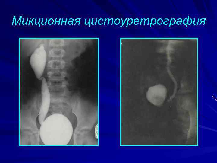 Цистография подготовка