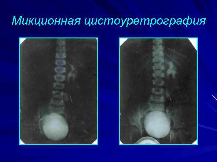 Микционная цистоуретрография 