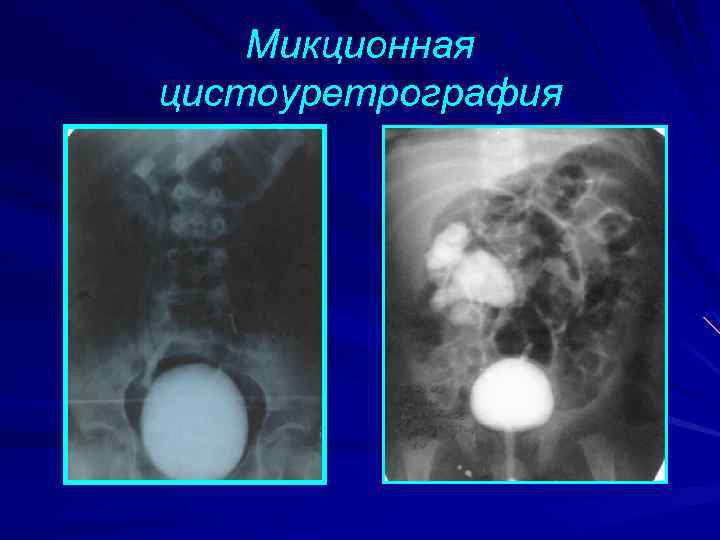 Микционная цистоуретрография 
