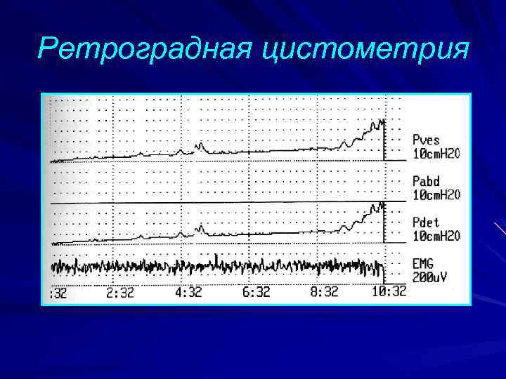 Ретроградная цистометрия 