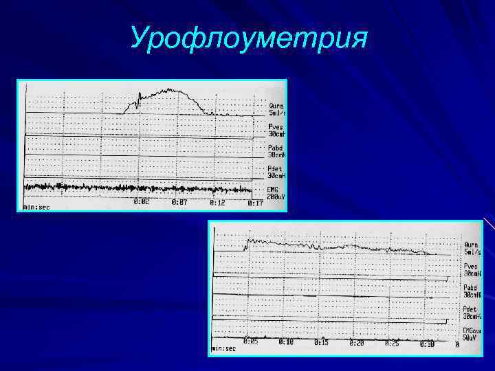 Урофлоуметрия как проводится. Урофлоуметрия расшифровка норма. Урофлоуметрия при нейрогенном мочевом пузыре. Урофлоуметрия ДГПЖ. Измерение скорости потока мочи урофлоуметрия.