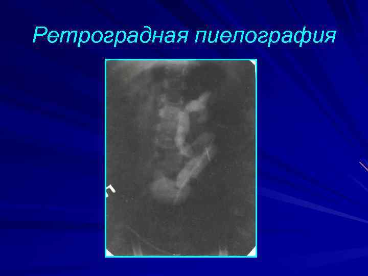 Ретроградная пиелография 