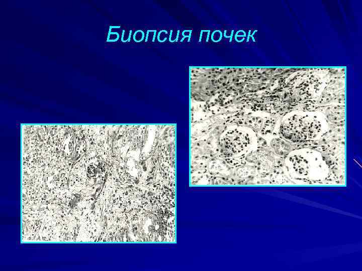 Биопсия почек 