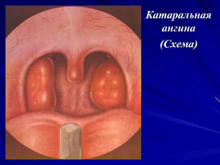 Катаральная ангина (Схема) 