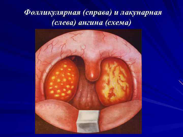 Фолликулярная (справа) и лакунарная (слева) ангина (схема) 