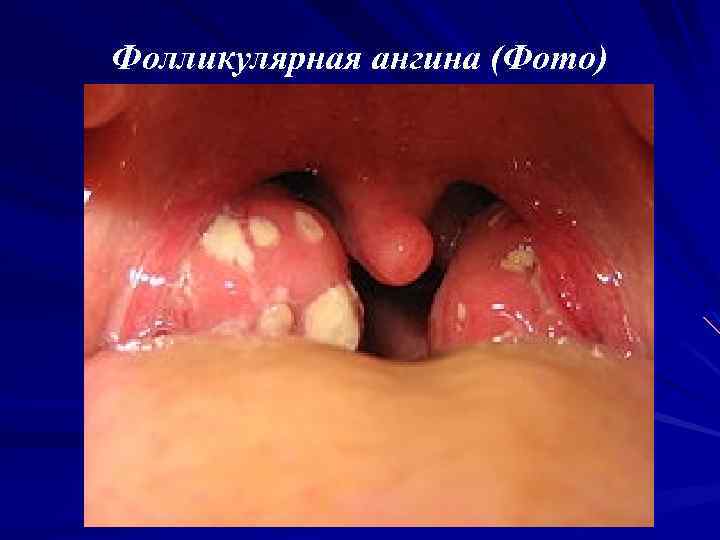 Фолликулярная ангина (Фото) 