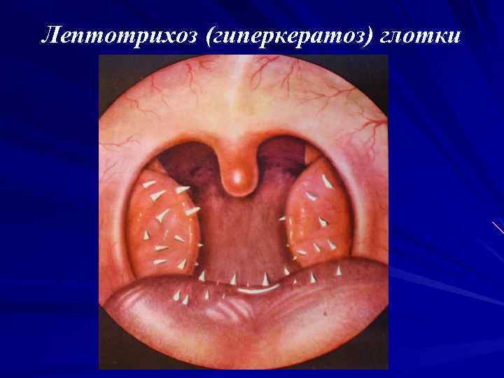 Лептотрихоз (гиперкератоз) глотки 